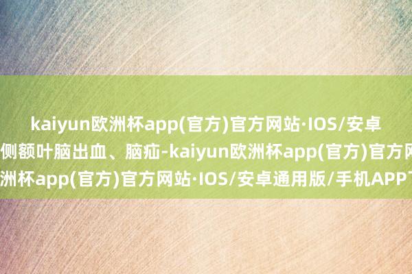 kaiyun欧洲杯app(官方)官方网站·IOS/安卓通用版/手机APP下载右侧额叶脑出血、脑疝-kaiyun欧洲杯app(官方)官方网站·IOS/安卓通用版/手机APP下载